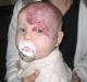 Все про гемангиомах у новонароджених дітей: причини виникнення, методи лікування і наслідки