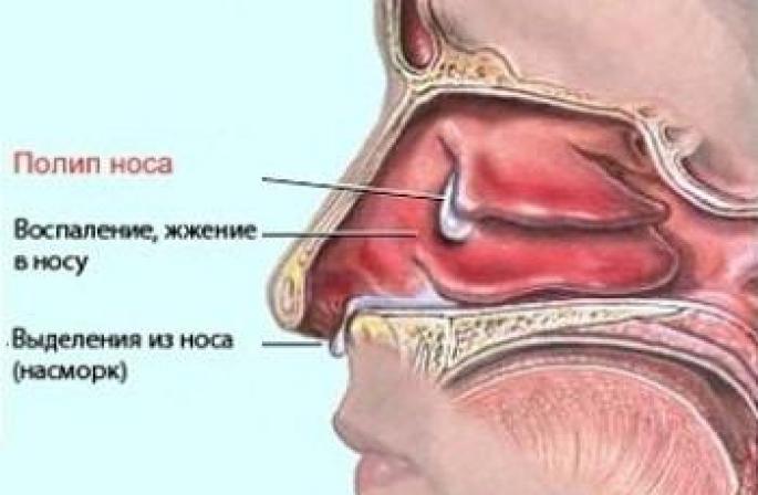 Поліпи в носі у дітей і дорослих: симптоми з фото і лікування