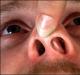 鼻整形 - 鼻の形成手術 鼻整形の方法