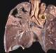 Tuberculose - symptômes et premiers signes